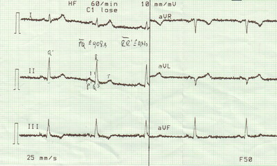 Standard ekg